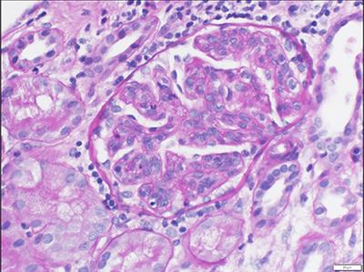 Hypocomplementemic Atypical IgA Vasculitis: A Case Report